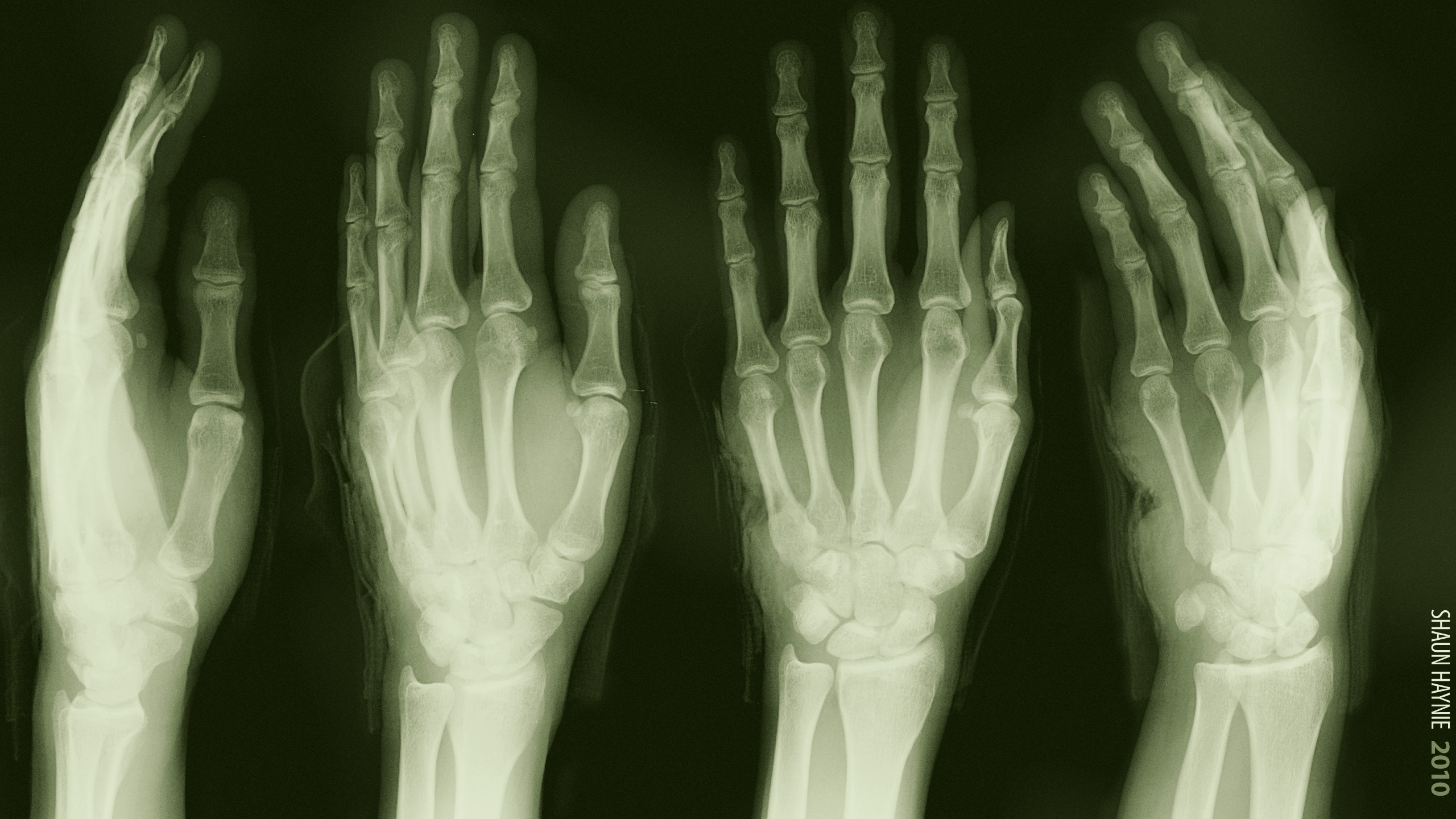 An X-ray of a hand showing a medical injury.